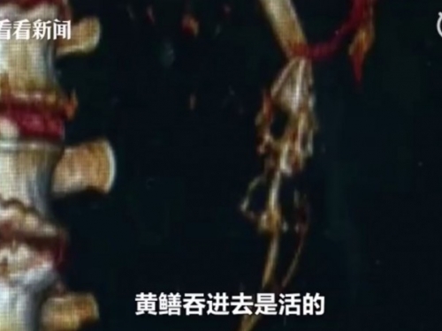 生吞活鱔魚治便秘？ 中國男誤信偏方腸穿孔命危