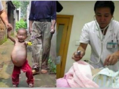 小孫女肚子竟漸漸變大，家人以為她只是肚子脹，最後開刀卻從肚子裡取出