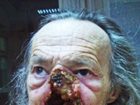 老翁罹罕病「全臉爛掉」　冷血醫院拒絕醫治：病情不緊急