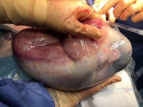 機率8萬分之1！ 西班牙女嬰在羊膜囊內出生「羊水沒破」