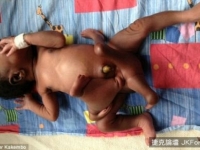 驚奇！烏干達誕生了一個　四手四足的嬰兒