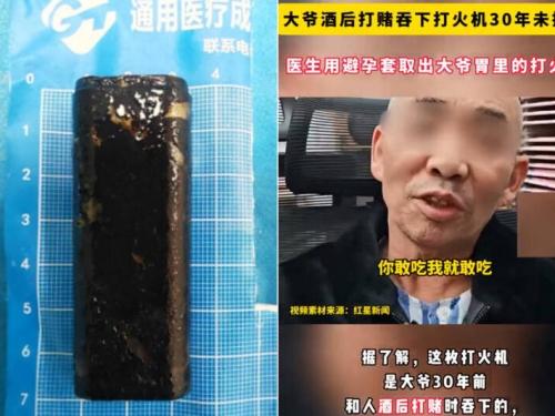 阿伯腹痛一照胃鏡嚇呆醫護！「打火機」藏胃裡30年仍可使用