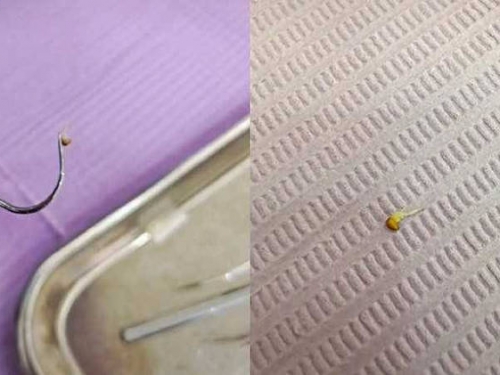 不愛清牙縫！ 牙醫從牙縫挖出草莓籽 定睛一看竟發芽