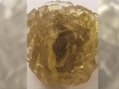 人妻膽囊驚藏罕見「玫瑰結石」 尪嗨喊：做成鑽戒