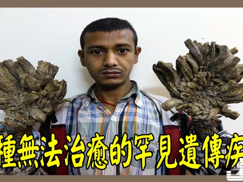 10種無法治癒的罕見遺傳疾病，人類尾巴也是一種遺傳疾病！你知道嗎？