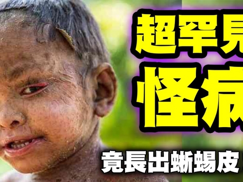 3個世界級罕見怪病｜究竟是什麼怪病讓這女孩長出猶如蜥蜴般的皮？是什麼原因讓這對...