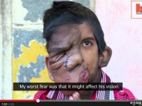 右眼長巨瘤被叫鬼！男童遭禁學　原因竟是其他人會怕　