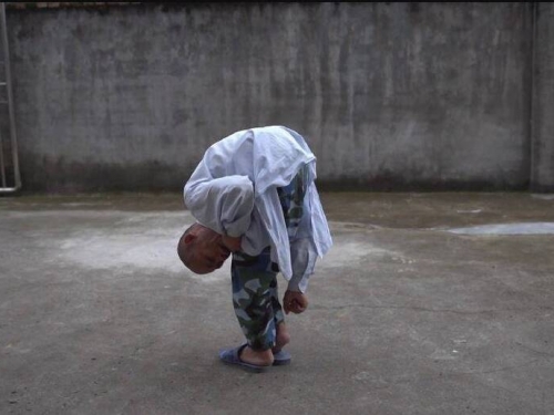 男子「臉貼膝蓋」30多年 歷經5次大手術終擺脫「摺疊人生」