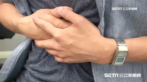 35歲男腹痛2年！X光驚見「60件異物」 別針、螺絲全吞了