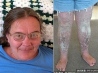 患病變「樹人」　自卑英婦不敢出門