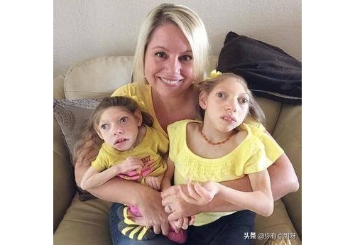 兩姐妹長大了外表卻還像嬰兒一樣 醫生說只能活到40歲