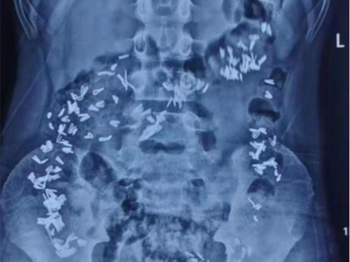 男童腹痛照X光驚見密集白點 醫一看傻眼：全是釘書針