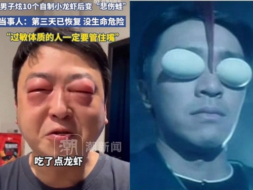 自製小龍蝦料理！ 男子把自己吃到腫成「鹹蛋超人」