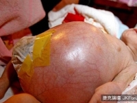 寶寶肚子為甚麼那麼大？7月大男嬰竟剖腹產下死胎