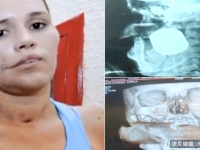 墨女被「未爆手榴彈」穿透臉　勇醫+拆彈師花4hr救回她