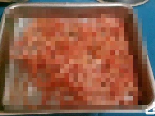 女子身體不適就醫 肚藏百隻活跳跳寄生蟲