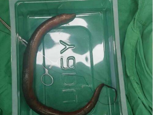 30cm黃鱔鑽進屁股直衝腹腔！ 他肚子僵硬、腸壁全是洞險喪命