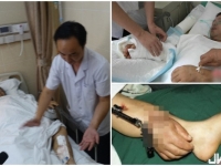 奇！江蘇男斷手寄養小腿一個月 現回植成功