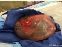 八萬分之一的醫學奇蹟！　早產兒包在羊膜囊內出生