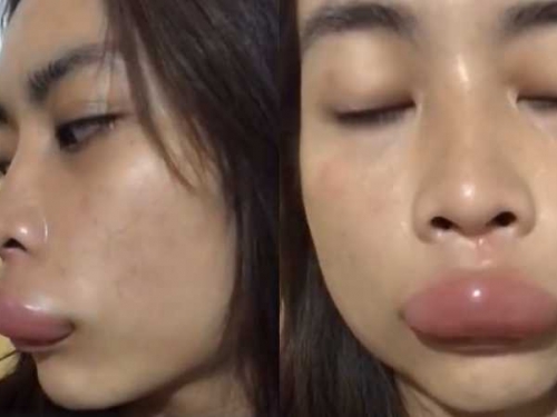 為點閱率拚了！女直播主吃蜂巢被狠螫…腫成「梁朝偉香腸嘴」爆紅